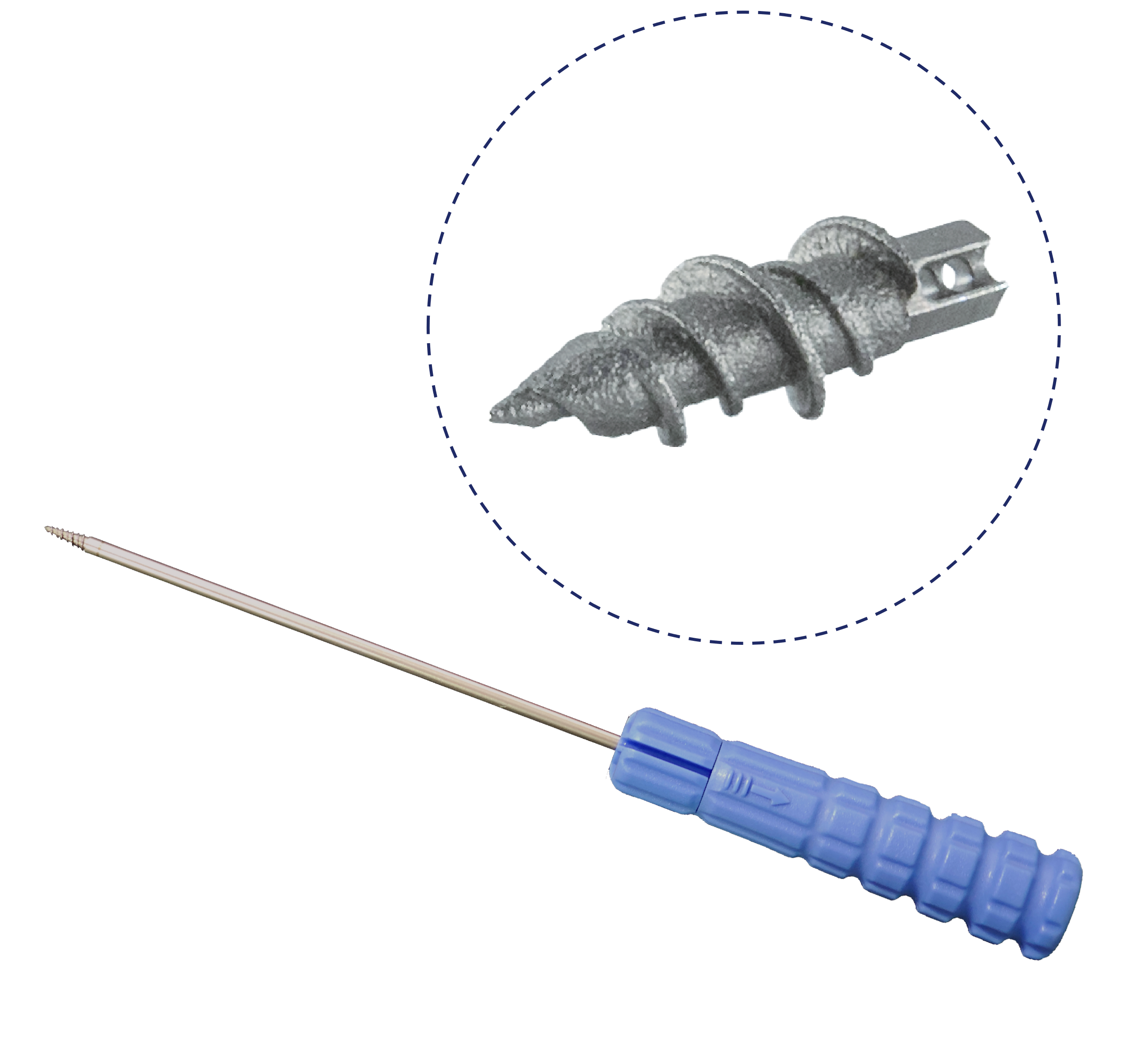 3D Printed Titanium Alloy Anchor